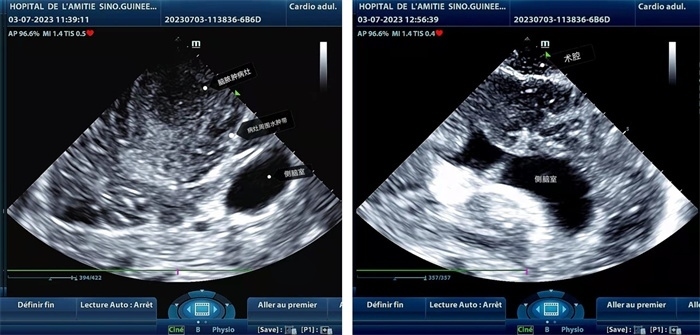 左圖顯示術(shù)中超聲見囊實性病變，大小約為4x4x3cm，病灶周圍腦組織水腫明顯；右圖為病灶切除后，術(shù)中超聲示術(shù)腔無病變殘留
