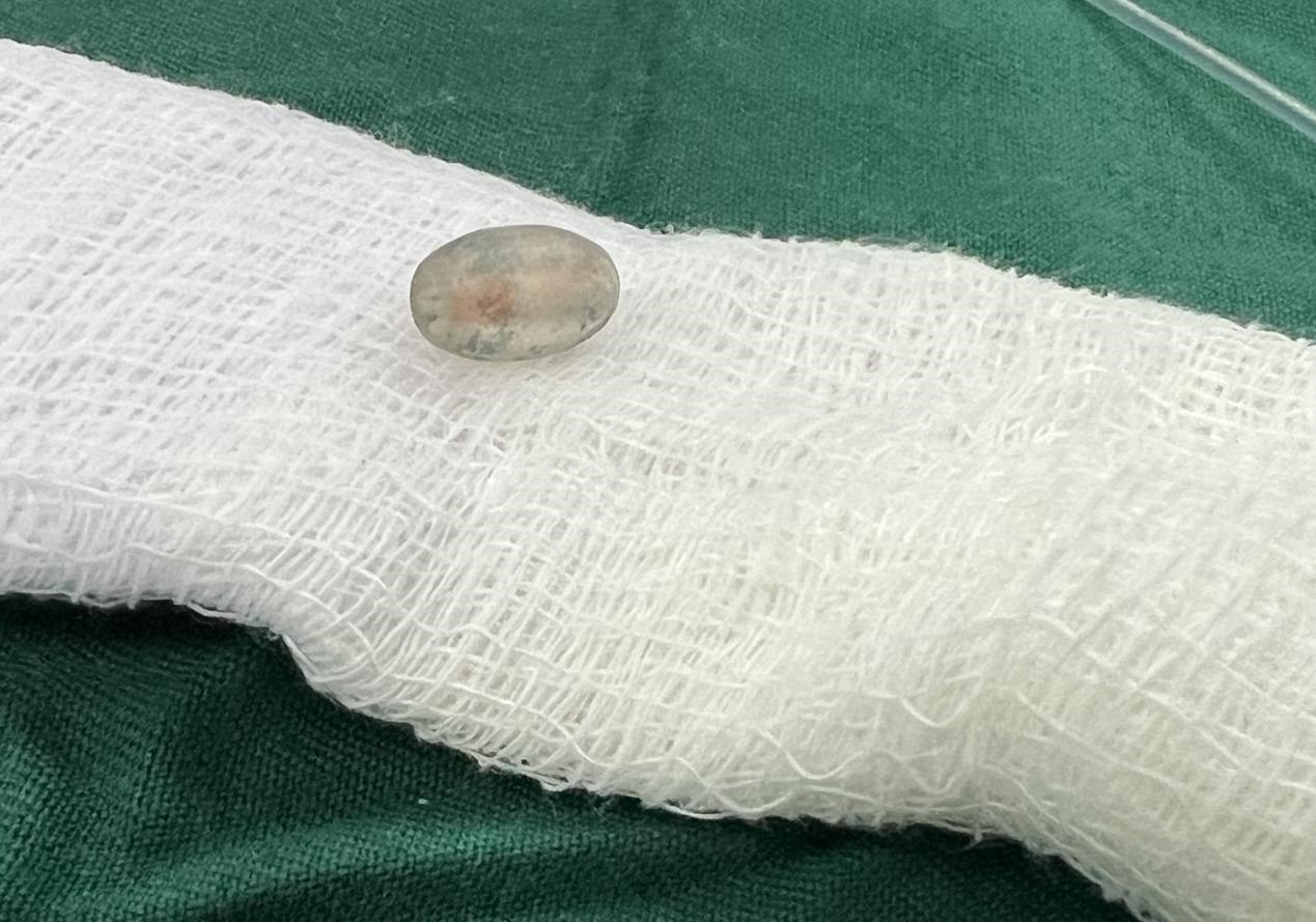 被取出的異物。中國(guó)援桑醫(yī)療隊(duì)供圖