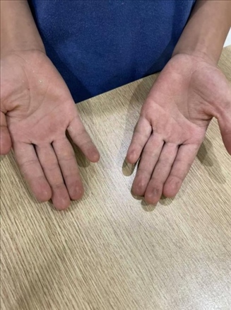 9歲小學(xué)生長(zhǎng)期拍煙卡，手部粗糙長(zhǎng)繭。受訪者供圖