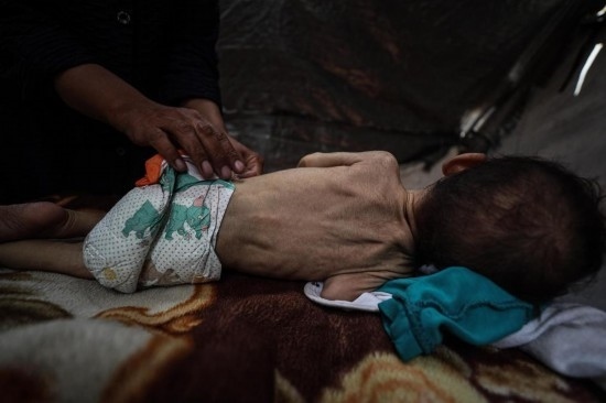 這是5月28日在加沙城西部一處臨時(shí)安置點(diǎn)拍攝的一名營養(yǎng)不良的嬰兒。新華社發(fā)（馬哈茂德·扎基攝）
